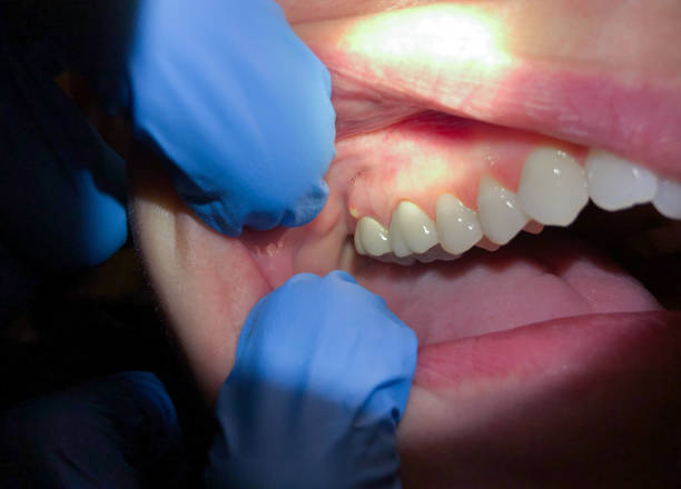 Best Emergency Dental Care for Broken or Chipped Teeth in East Oakdale, CA