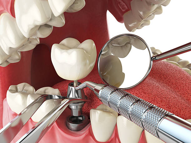 Best Emergency Tooth Extraction in East Oakdale, CA